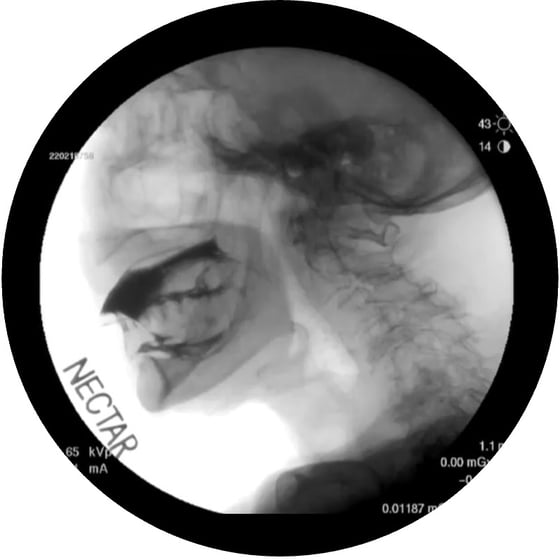 dysphagia